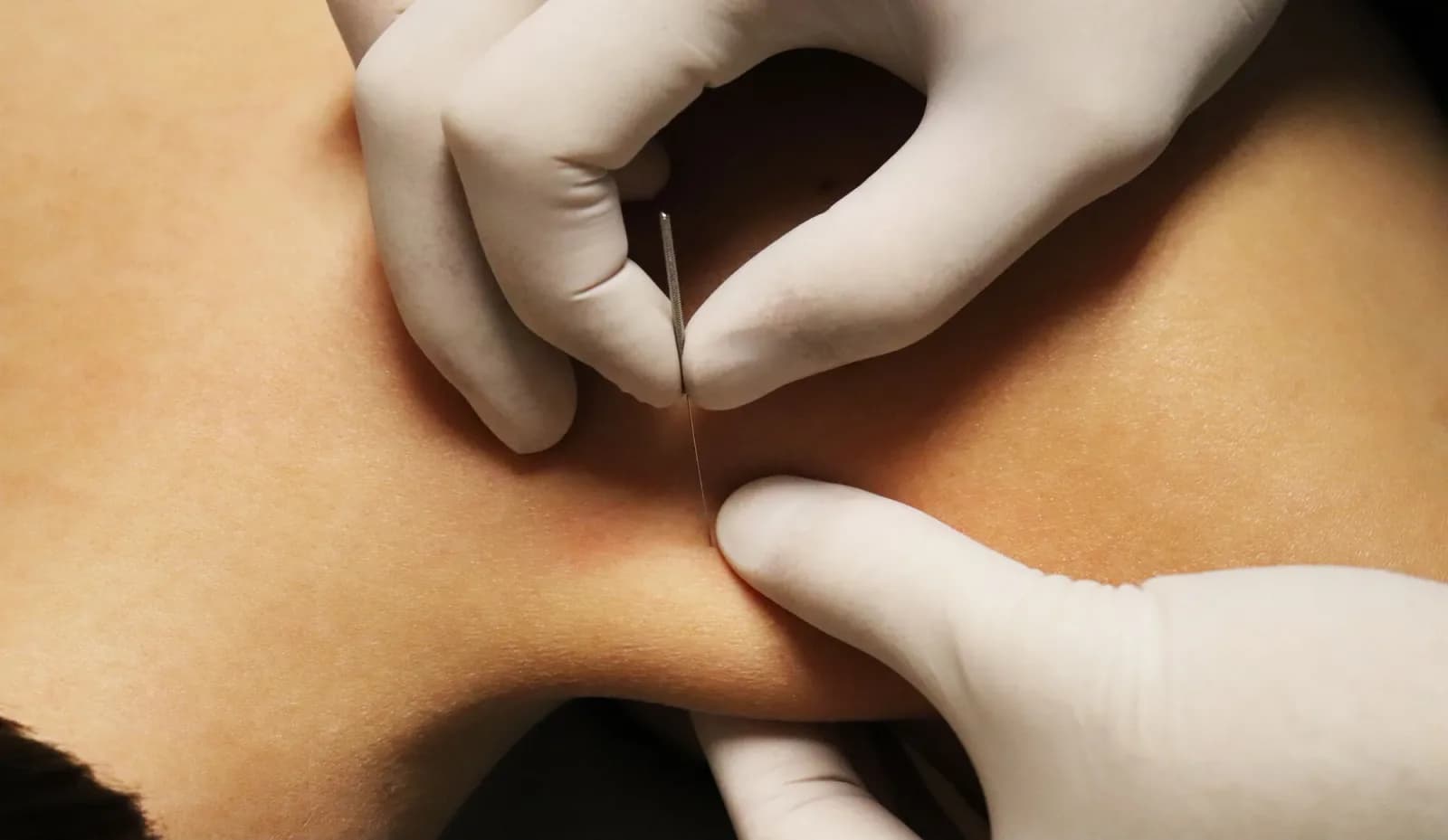 Dry Needling "myofasziales Schmerzmanagement"